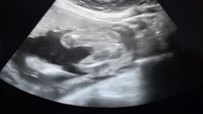 Georgia erlässt kontroverses Abtreibungsgesetz